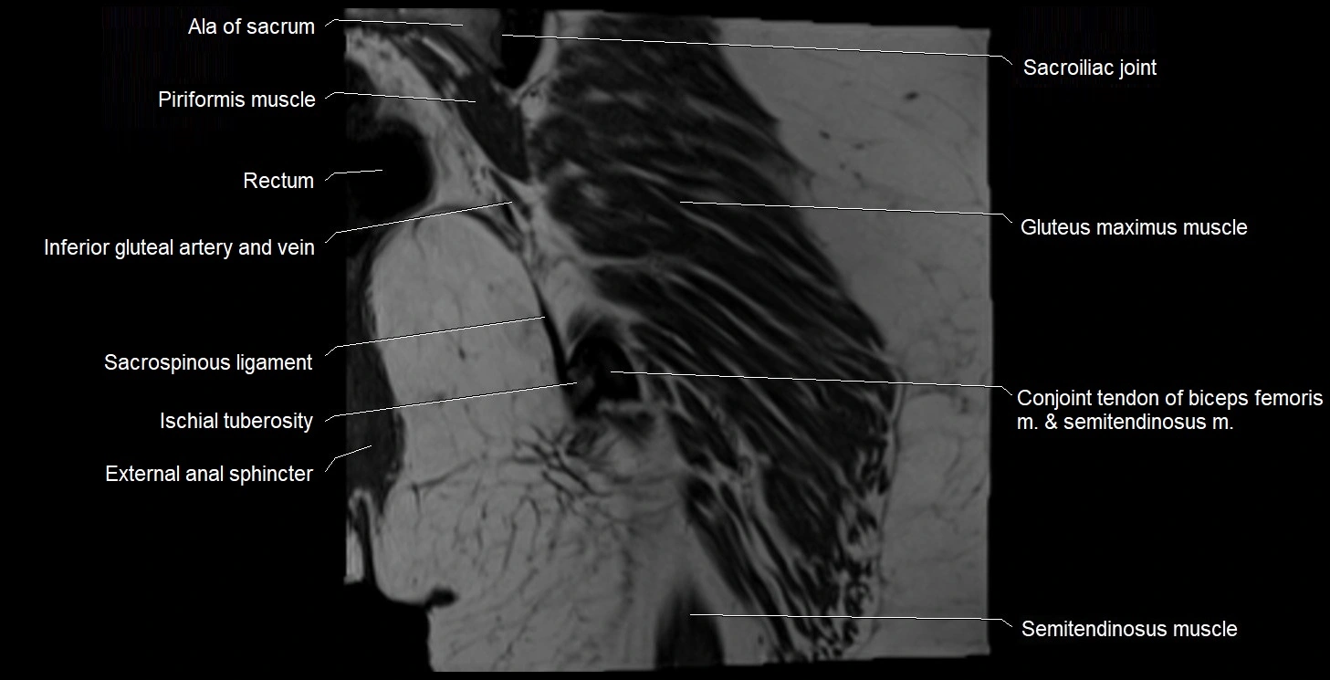 MRI Hip 3T coronal cross sectional anatomy image 56.webp
